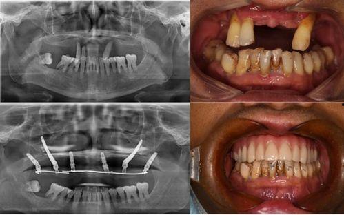 佛山种牙爆料事件最新,揭露行业乱象，患者权益如何保障？  第3张