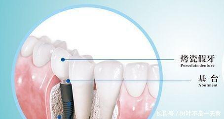 爆料种植牙套路视频,视频爆料揭露惊人内幕